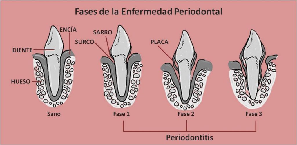 Esquema de fases de la enfermedad periodontal